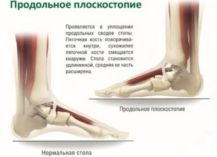Picioare longitudinale plate de grade diferite - fotografie de deformare a piciorului