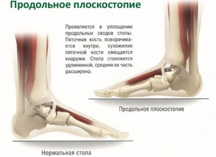 Поздовжнє плоскостопість різних ступенів - фото деформації стопи