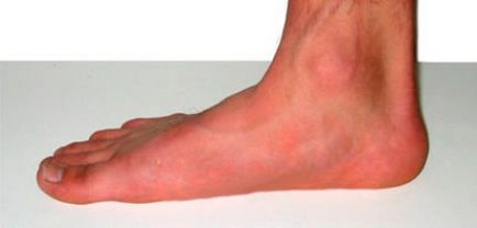 Picioare longitudinale plate de grade diferite - fotografie de deformare a piciorului