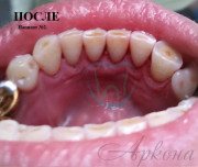 Професійна гігієна - Аркона стоматологія