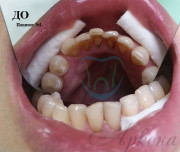 Професійна гігієна - Аркона стоматологія