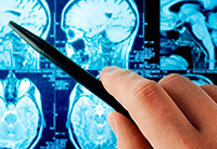 Prevenirea atacului cerebral - un memento pentru prevenirea unei boli periculoase