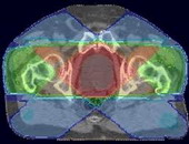 Radioterapia modulată de intensitate a cancerului (imrt) în Israel