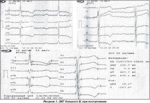 Disecția anevrismică a aortei, simptome, tratament, cauze, diagnostic