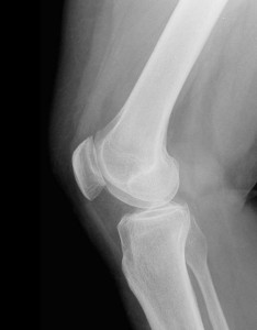 Рентген колінного суглоба що можна розгледіти на знімку