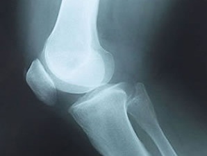 Рентген колінного суглоба що можна розгледіти на знімку