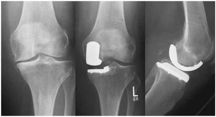 Roentgen al articulației genunchiului care poate fi văzut în imagine