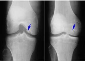 Roentgen al articulației genunchiului care poate fi văzut în imagine