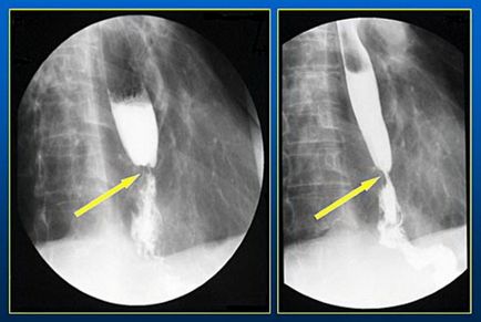 X-ray (radiografie) a esofagului cu preparat de bariu, conducție