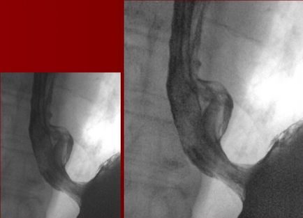 X-ray (radiografie) a esofagului cu preparat de bariu, conducție