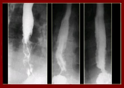 Рентген (рентгенографія) стравоходу з барієм підготовка, проведення