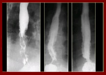 X-ray (radiografie) a esofagului cu preparat de bariu, conducție