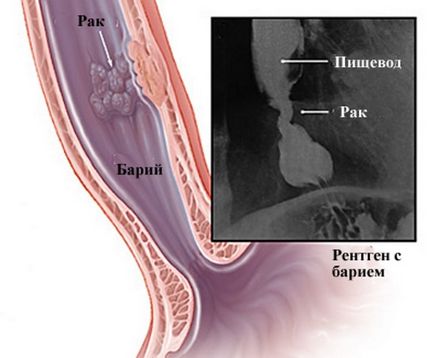 X-ray (radiografie) a esofagului cu preparat de bariu, conducție