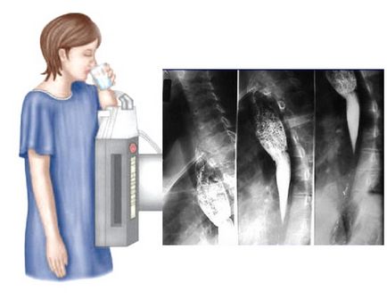 X-ray (radiografie) a esofagului cu preparat de bariu, conducție