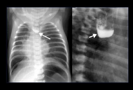 Рентген (рентгенографія) стравоходу з барієм підготовка, проведення