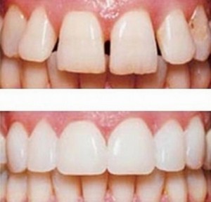 Restaurarea dinților, o revizuire a metodelor și a materialelor