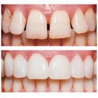 Restaurarea dinților, o revizuire a metodelor și a materialelor
