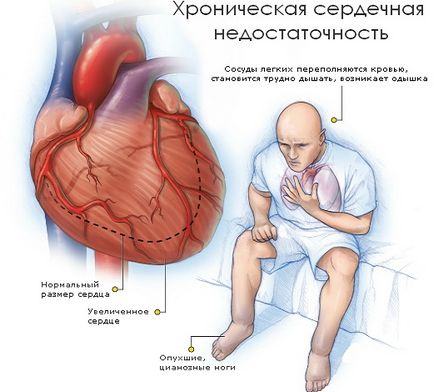 Eșecul cardiovascular este o boală sau o afecțiune