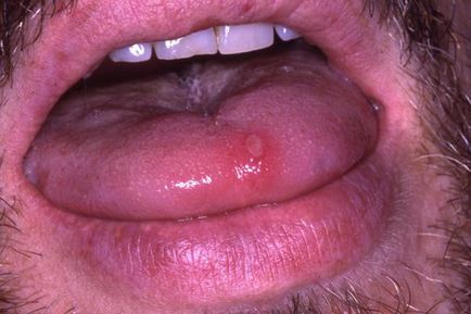 Sifilis fotografie primară a erupțiilor cutanate, primele semne și simptome