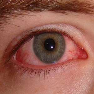 Симптоми і причини розвитку алергії на чихуахуа - все про алергію