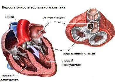 Симптоми пороку серця у новонароджених дітей і дорослих