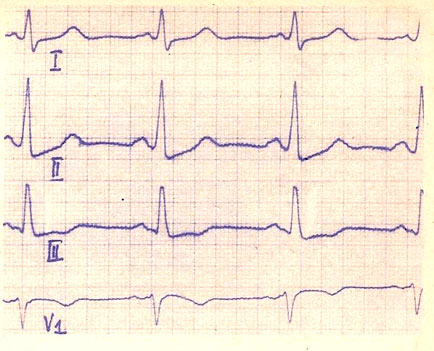 Sindromul intervalului scurtat p - ghidarea privind electrocardiografia clinică a copilăriei