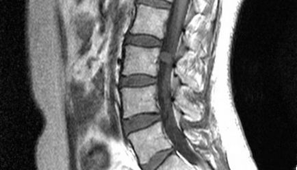 Syringomyelia coloanei vertebrale cervicale și toracice