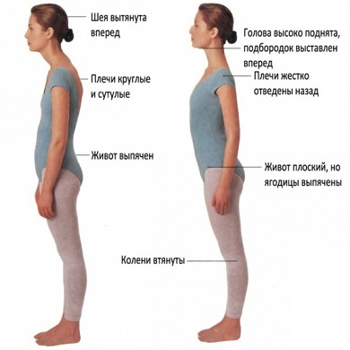 Сколіоз грудного відділу хребта - симптоми, ступеня, лікування, вправи, фото