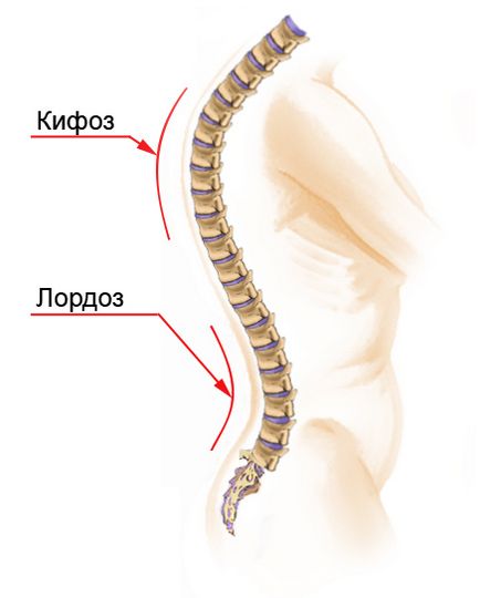 Scolioza coloanei vertebrale toracice - simptome, grade, tratament, exerciții, fotografie