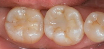 Скільки коштує поставити пломбу на зуб - передній і корінний