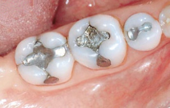 Скільки коштує поставити пломбу на зуб - передній і корінний