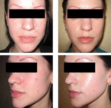 Mediana peeling fata de metode fizice si chimice, contraindicatii, soiuri