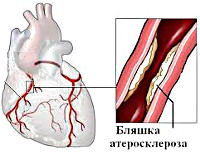 Angina pectorală - cauze, simptome, diagnostic și tratament