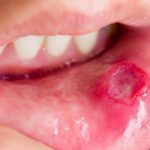 Стоматит на губі причини появи, симптоми і лікування