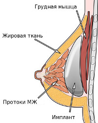 Poziția subglangulară a implantului