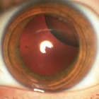 Subluxarea și luminarea lentilelor lentilelor - cauze, diagnostice și terapii eficiente