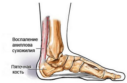 Тендиніт ахіллового сухожилля причини, симптоми, лікування
