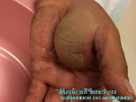 Arsurile mâinii termice - membrele superioare