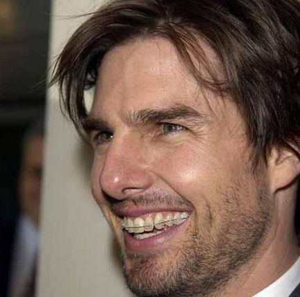 Tom Cruise a fogak előtt és után helyreállítás