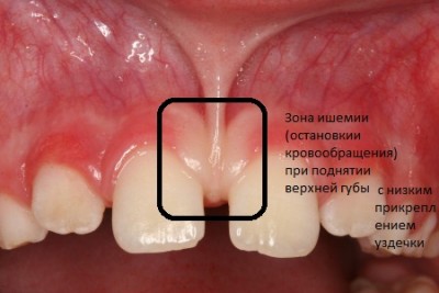 Треми і діастеми між зубами