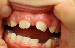 Három vagy diastema fogak közötti