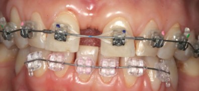 Trema și diastema dintre dinți