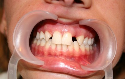 Треми і діастеми між зубами