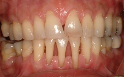 Întărirea gingiilor cu medicamente parodontale, remedii de la domiciliu