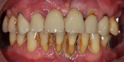 Întărirea gingiilor cu medicamente parodontale, remedii de la domiciliu
