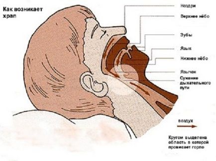 Хъркането упражнения, гимнастика, профилактика и лечение