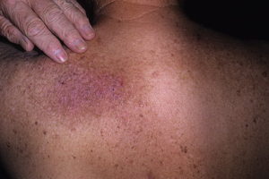 Care este diferența dintre eczeme și neurodermitis?