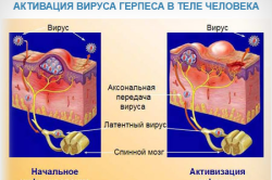 Вітрянка і герпес