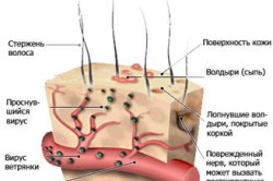 Вітрянка і герпес