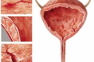 Tipuri de simptome de Cistita, Cauze, Diagnostic, Tratament